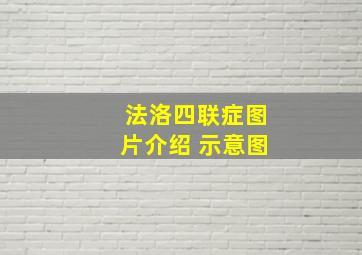 法洛四联症图片介绍 示意图